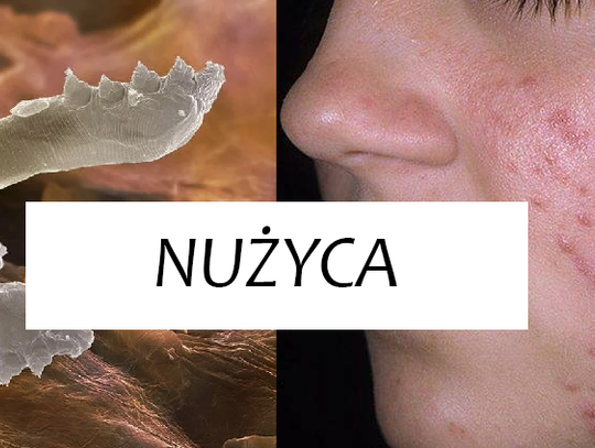 Nużyca – sprawdź, co warto wiedzieć